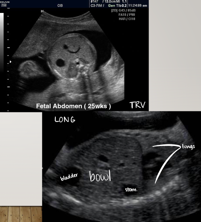 <ul><li><p>scanned in TRV plane (short axis)</p></li><li><p>anechoic (fluid-filled)</p></li><li><p>if stomach is empty, move on and come back later or have patient come back another day</p></li><li><p>can also image stomach and bladder together in LONG</p></li></ul><p></p>