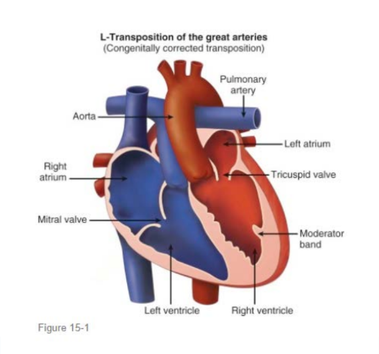 <p>Congenitally corrected transposition of the great arteries, or <strong>CCTGA</strong>, is a cardiac structural abnormality with <strong>double discordance</strong>:</p><ol><li><p>Atrioventricular discordance</p></li><li><p>Ventriculoarterial discordance</p></li></ol><p>Because there are 2 abnormal connections, the blood is redirected back into the correct circulation.</p><p>Also known as <strong>LTGA, Double discordance,</strong> physiologically corrected TGA, and <strong>ventricular inversion</strong></p>