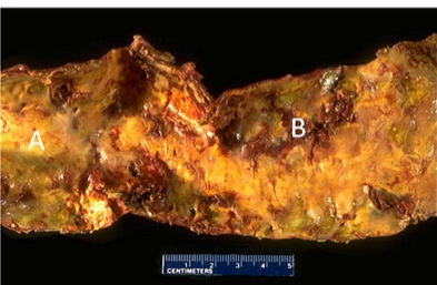 <p>aorta with an atheromatous plaque</p>