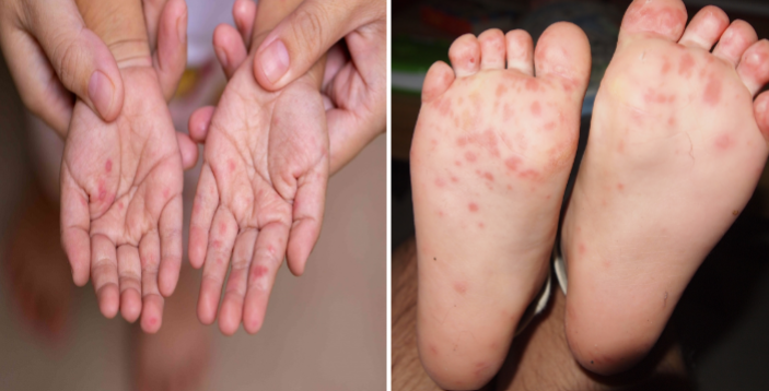 <p>hand-foot-and-mouth (HFM) disease</p>
