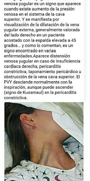 <p>Hinchazón o abultamiento visible de las venas yugulares en el cuello</p>