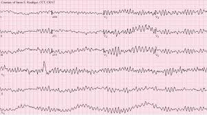 <ul><li><p>Uncoordinated contraction of the heart muscle.</p></li><li><p>ECG appears <strong>irregular and chaotic</strong>.</p></li><li><p>Heart pumps blood less effectively.</p></li></ul><p></p>