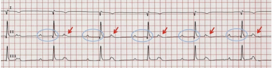 <p>Which degree AV block is this? What is featured on this ECG?</p>