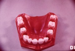 <p>An elevated structure in the occlusal one-half to one-third of the proximal surface of the crown</p>