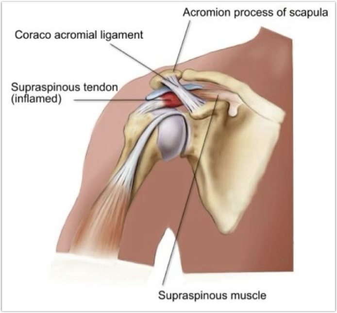 <ul><li><p>compression of the supraspinatus tendon, subacromial bursae, or long head of the biceps tendon as the space below the coracoacromial arch is limited (getting hit, an inflamed area)</p></li><li><p>seen a lot in overhead athletes</p></li></ul><p></p>