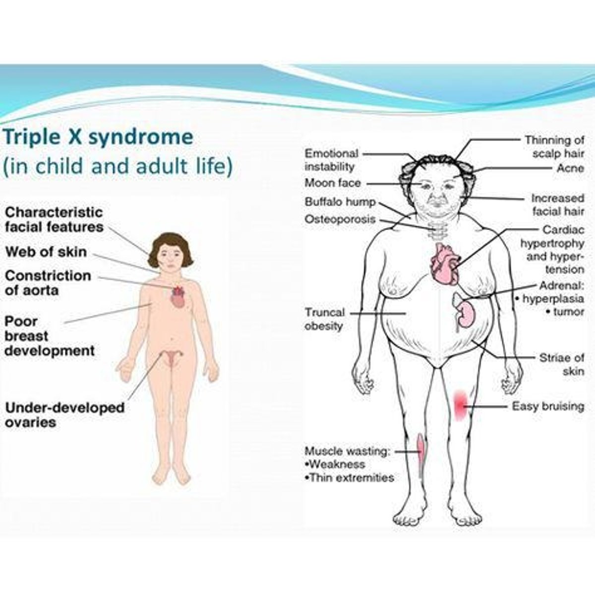 <p>- Its characteristics are a Female, normal appearance, menstrual irregularities, learning disorders, and intellectual disability</p><p>- Its Incidence 1 in 1,000 female births</p><p>- Its treatment is Special education</p>