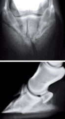 <p>What are type V P3 fractures like?</p>