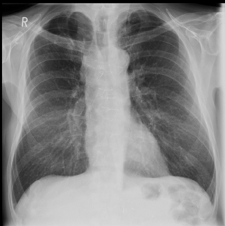 <p><span>Male 60 years. Recent onset of shortness of breath and wheezing</span></p>