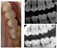 <p>What is the treatment for #12?</p><p>Findings:</p><p>- Visual: Sound</p><p>- Radiographic: D- Moderate</p>