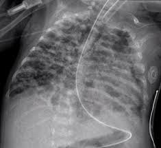 <p>Chronic lung disease in preterm infants (<32 wks) with prolonged oxygen/mechanical ventilation → alveolar simplification & fibrosis</p><p><span style="font-family: "Times New Roman", serif;">Oxygen dependence >28 day</span></p><p><span> <strong>Chest X-ray: hazy opacities, hyperinflation</strong></span></p><p>clinical dx </p>