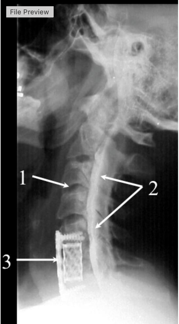 <p>what intervertebrak disk space is at #1</p>
