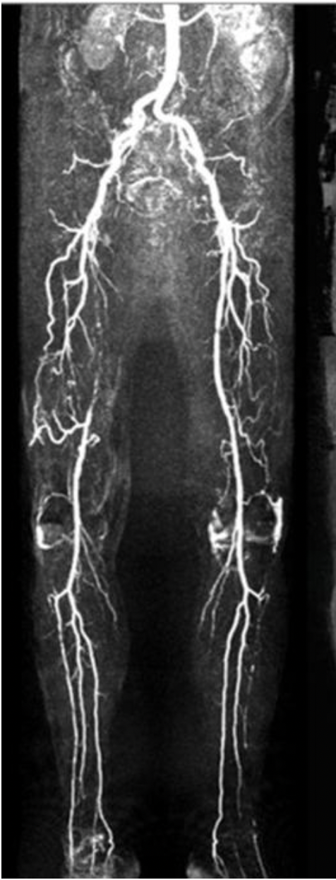 <p>You are about to perform a lower extremity arterial duplex on a patient that recently had an MRA run-off exam. According to the attached image, what vessel will demonstrate reduced or absent flow in the right leg?</p><p class="p1">A. posterior tibial artery</p><p class="p1">B. superficial femoral artery</p><p class="p1">C. common femoral artery</p><p class="p1">D. anterior tibial artery</p>