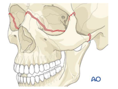 <p>Fx through frontozygomatic sutures, orbits, nose, and ethmoids (+ frontal bone = IV)</p><p>*entire face mobile, unstable, +/- CSF leak (cribiform plate)</p><p>Admit + IV ABX</p>