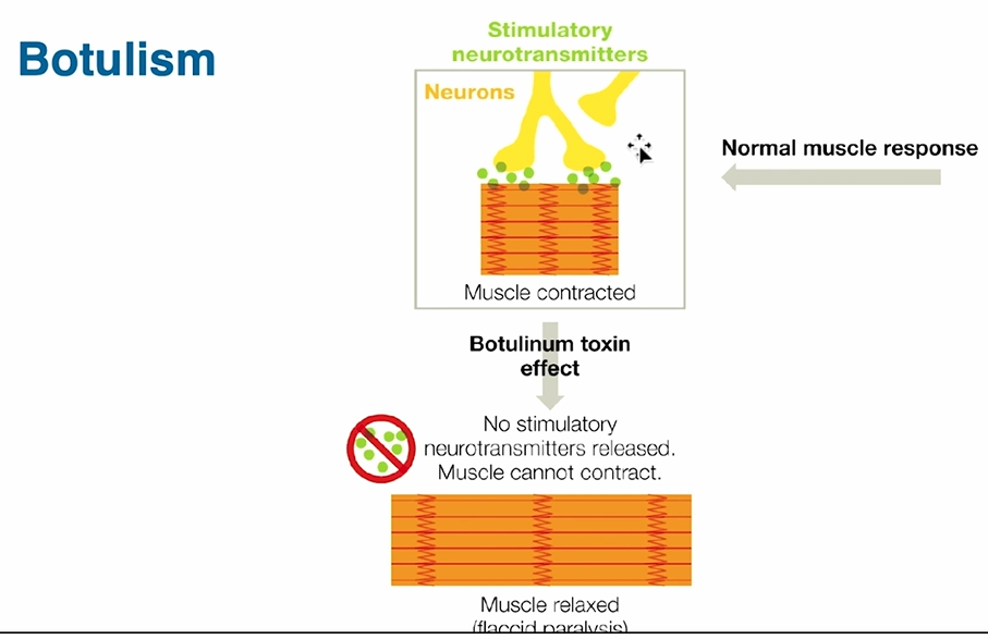 <p>caused by C. botulinum’s paralyzing botulinum neurotoxin, which causes flacid paralysis</p>