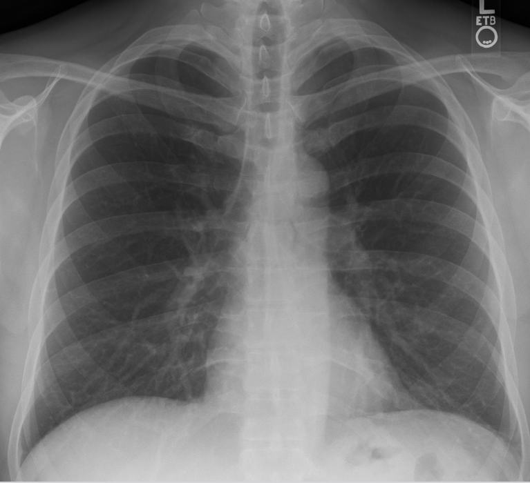 <ul><li><p>x-ray source on one side of patient &amp; x-ray detector on the other side </p></li><li><p>short duration (<1.2 second) pulse of x-rays is emitted by the tube</p><ul><li><p>most rays interact with the patient</p></li><li><p>some pass throught the patient and reach the detector </p></li></ul></li></ul><p></p>