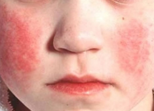 <p>Fifth Disease (erythema infectiosum) presentation*</p>