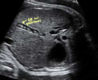 <p><strong>cholelithiasis</strong></p><ul><li><p>uncommon in fetus; usually resolve in utero or childhood</p></li></ul><p><strong>choledochal cyst</strong></p><ul><li><p><span style="color: red;">dilation of CBD</span></p></li><li><p>presents as <span style="color: red;">cystic mass adjacent to GB</span></p></li></ul><p><strong>biliary atresia</strong></p><ul><li><p><span style="color: red;">absence of GB</span></p></li><li><p>may be associated with polysplenia </p></li></ul><p></p>