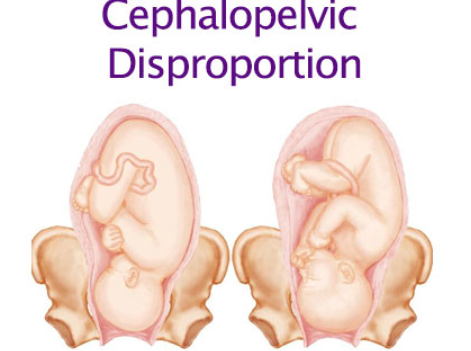 <ol><li><p><span style="color: rgb(240, 86, 86);"><strong>placenta previa</strong></span></p></li><li><p><strong>umbilical cord </strong><span style="color: rgb(110, 191, 54);"><strong>prolapse</strong></span></p></li><li><p><span style="color: rgb(66, 173, 193);"><strong>prior cesarean</strong></span></p></li><li><p><span style="color: rgb(73, 33, 198);"><strong>cephalopelvic disproportion</strong></span>(baby’s head too big to fit through pelvis)</p></li><li><p><span style="color: rgb(205, 29, 215);"><strong>fetal distress</strong></span><strong> </strong>(breech)</p></li></ol><p></p>