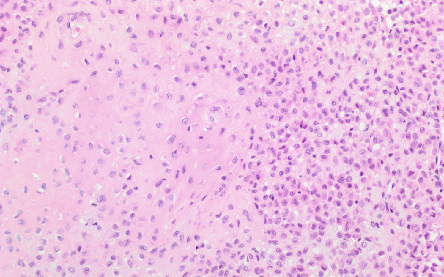 <p>Tumeur homme de 20 ans, sous chondrale, épihyse fémur </p><p>diagnostic</p><p>définition</p><p>age</p><p>topographie</p><p>anatomie</p><p>histologie</p><p>moléculaire</p>