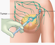 <p><span>The picture shows Sentinel lymph node removed for biopsy:</span></p>