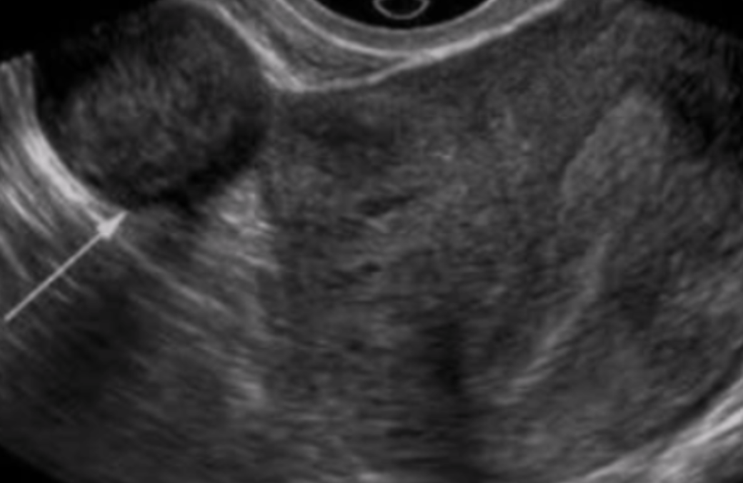 <p>Name the type of fibroid and its location</p>