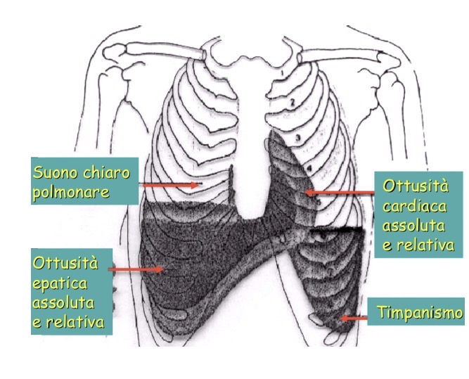 <p><span>• Manovra: Percuotere con l'articolazione tra ultima falange e falange intermedia del dito medio (plessimetro), posizionando il dito parallelamente alle coste negli spazi intercostali.</span></p><p><span>• Funzione: Determina densità polmonare, alterazioni, confini organi (percussione Topografica) o alterazioni simmetriche (percussione Comparativa).</span></p><p><span>• </span><strong><span>Caratteristiche del suono plessico:</span></strong></p><p><span>• Frequenza: Iperchiaro (basso/grave), Chiaro (basso/grave), Ottuso (acuto/alto).</span></p><p><span>• Ampiezza: Iperfonetico (intenso/forte), Ipofonetico (meno ampio/forte), Timpanico/Non Timpanico.</span></p><p><span>• </span><strong><span>Tipi di Suoni e patologie associate:</span></strong></p><p><span>• </span><strong><span>Suono chiaro polmonare (Risonanza):</span></strong><span> Forte, tono basso, durata lunga. Normale.</span></p><p><span>• </span><strong><span>Suono piatto:</span></strong><span> Debole, alto, breve (simile a coscia). Causa: </span><strong><span>Versamento pleurico massivo</span></strong><span>.</span></p><p><span>• </span><strong><span>Suono ottuso:</span></strong><span> Intensità, tono e durata medi (simile a fegato). Cause: </span><strong><span>Polmonite lobare</span></strong><span> (addensamento parenchima), liquido (</span><strong><span>versamento/emotorace</span></strong><span>), tessuto non areato (</span><strong><span>neoplasia, fibrosi</span></strong><span>).</span></p><p><span>• </span><strong><span>Iperrisonanza:</span></strong><span> Molto forte, tono più basso, durata più lunga. Cause: </span><strong><span>Enfisema polmonare</span></strong><span> (distruzione setti), crisi in </span><strong><span>paziente asmatico</span></strong><span> (polmone iperinsufflato), </span><strong><span>pneumotorace</span></strong><span>.</span></p><p><span>• </span><strong><span>Timpanismo:</span></strong><span> Forte, tono alto (simile a guancia gonfia/bolla gastrica). Cause: </span><strong><span>Pneumotorace, grossa bolla di enfisema</span></strong><span>.</span></p><p><span>• </span><strong><span>Zone di percussione specifiche:</span></strong></p><p><span>• Apici (Campi di Kronig): Partendo dall'alto (spalle). Fondamentale per sospetto </span><strong><span>Tubercolosi</span></strong><span>.</span></p><p><span>• Percussione delle basi (escursività): Percuotendo in respirazione normale si trova passaggio da chiaro a ottuso. Con inspirazione profonda, il margine si abbassa fisiologicamente da </span><strong><span>T10 a T12</span></strong><span> (escursione </span><strong><span>5-6 cm</span></strong><span>).</span></p><p><span>• Alterazioni escursione basi: Asimmetria indica </span><strong><span>patologia diaframmatica</span></strong><span> (paralisi) o </span><strong><span>versamento pleurico</span></strong><span>. Basi inferiori a T10 con ridotta escursione indicano polmoni iperinsufflati (</span><strong><span>enfisema</span></strong><span>).</span></p><p><span>• Area di ottusità cardiaca (sinistra): Si riduce se polmone è iperinsufflato (</span><strong><span>enfisema</span></strong><span>).</span></p><p><span>• Area di Traube (stomaco, suono timpanico): Sparisce se c'è aumento di cuore, fegato, milza o </span><strong><span>neoplasia gastrica</span></strong><span>.</span></p>