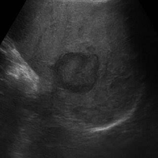 <p>slightly hypo mass with a hypoechoic halo </p>