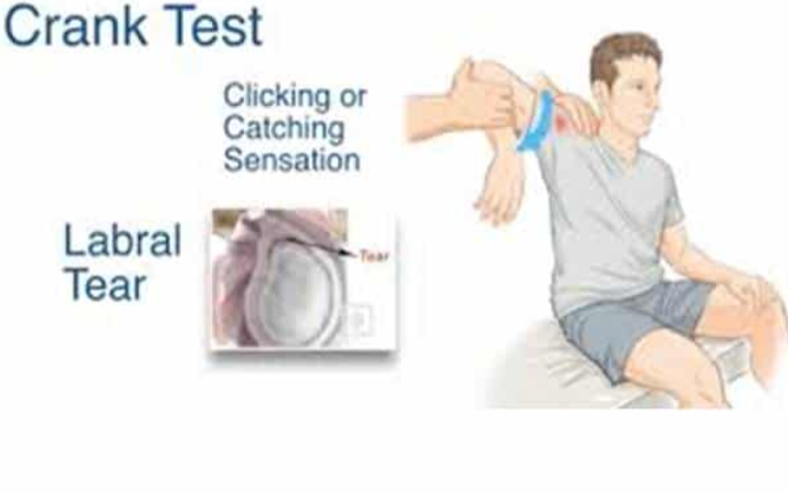 <p>While lying down, lift the arm overhead and rotate it. If you feel or hear a “clunk,” it’s positive.</p>