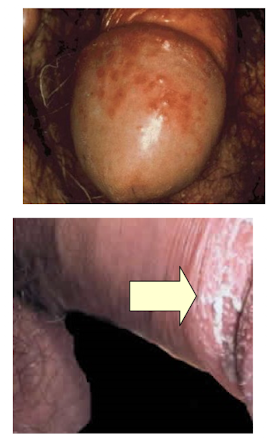 <ul><li><p>Inflammation of the glans penis</p></li><li><p>redness</p></li><li><p>pain</p></li><li><p>tenderness</p></li><li><p>swelling</p></li><li><p>irritation</p></li><li><p>discomfort</p></li><li><p>possible infection due to smegma accumulation.</p></li></ul><p></p>