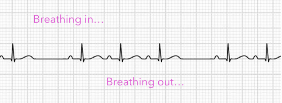 <p>Normal sinus P waves, but R-R intervals vary</p><ul><li><p>Typically occurs in young, healthy people, in which the reflex changes in vagal tone during breathing</p><ul><li><p>Sinus rate increases with inhaling, and decreases with exhaling</p></li></ul></li></ul><p></p>