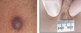 <p>Dermatofibromas - definition, sx, what sign, location*</p>