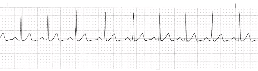 <p><em>Rhythm originating from the SA node that meets the following ECG criteria:</em></p><p>i.) <strong>Rate </strong><span><strong>→</strong></span><strong> </strong>Atrial and ventricular rates of 60 to 100 beats/min</p><p>ii.) <strong>Rhythm </strong><span><strong>→</strong></span><strong> </strong>Atrial and ventricular rhythms regular</p><p>iii.) <strong>P waves </strong><span><strong>→</strong></span> Present, consistent configuration; one P wave before each QRS complex</p><p>iv.) <strong>PR interval </strong><span><strong>→</strong></span> 0.12 to 0.20 second and constant</p><p>v.)  <strong>QRS duration </strong><span><strong>→ </strong></span>0.06 to 0.11 second and constant</p>