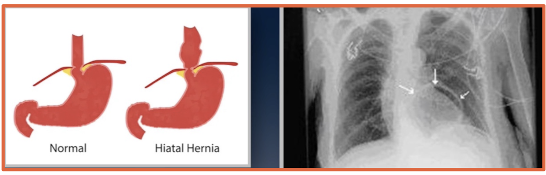 <p>Part of the stomach herniates upward through the esophageal hiatus</p>