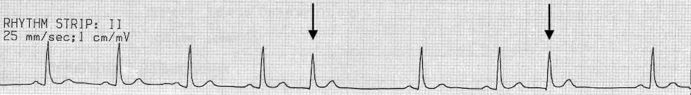 <p>Rate: depends on underlying rhythm </p><p>Regularity: irregular </p><p>P waves are either absent, in QRS, after QRS, or inverted before QRS</p>