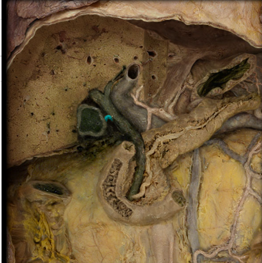 <p>duct from the gallbladder, carries bile from the common hepatic duct to the gallbladder, or from the gallbladder to the common bile duct</p>