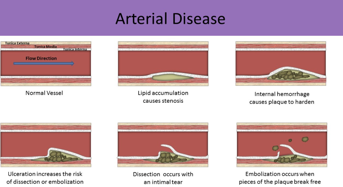 <ul><li><p>intimal layer tears and allows flow between the intima and media layers into a blind pocket (false lumen)</p></li><li><p>causes weakened vessel wall</p></li><li><p>risk of vessel rupture</p></li><li><p>most common at aortic arch</p></li><li><p>thrombosis can occur in false lumen → stenosis/occlusion and ischemia distal to dissection</p></li></ul><p></p>