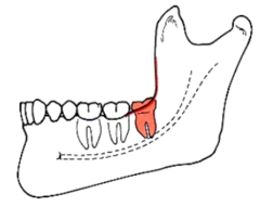 <p>Which anterior ramus relationship (Pell&Gregory)? </p><p>- Mesiodistal diameter of crown completely anterior to ramus</p>