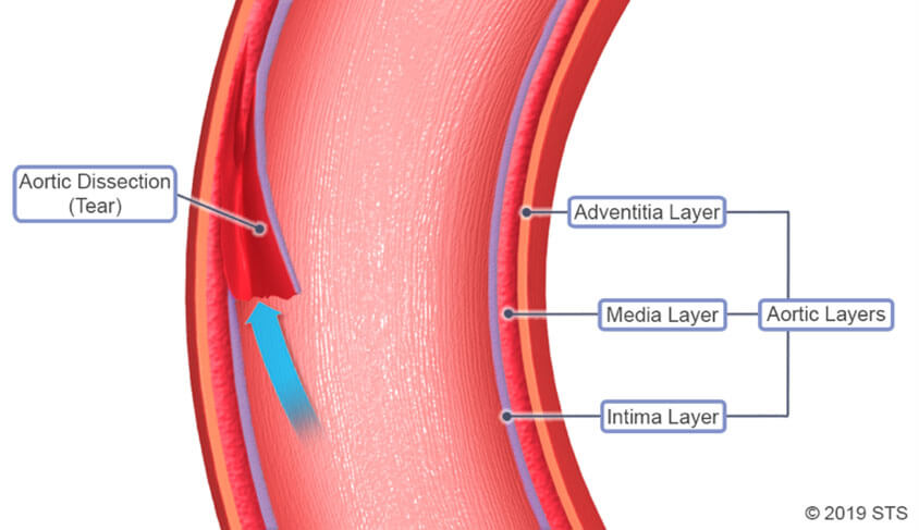 <p><strong>AORTIC DISSECTION</strong></p>