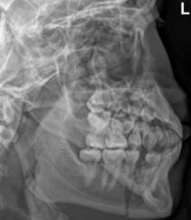 <p><span style="background-color: transparent;">Mandible - Axiolateral OBL</span></p>