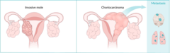 <p>An aggressive type of gestational trophoblastic neoplasia.</p>