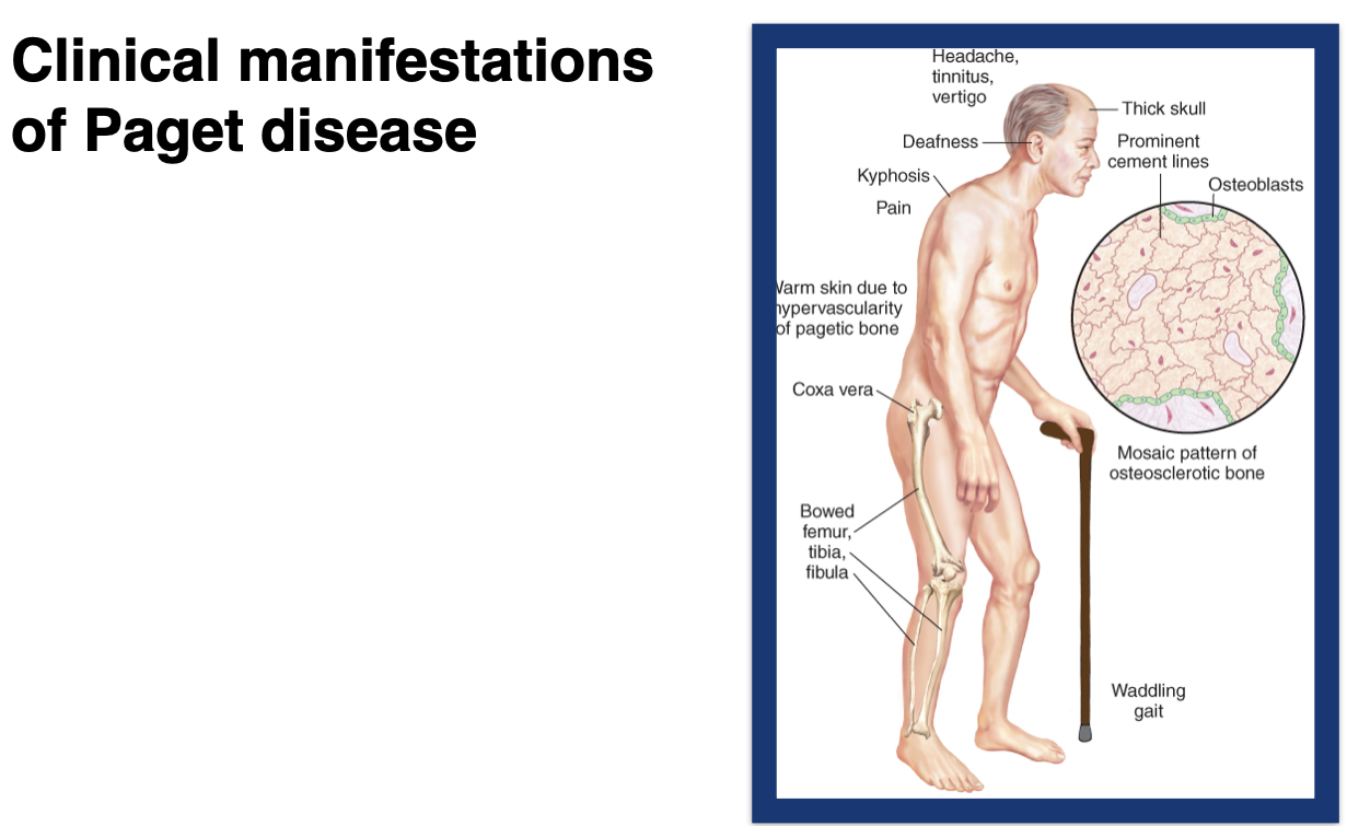 <ul><li><p>meds</p><ul><li><p>bisphospnates work by controlling the excessive breakdown and formation of bone that happens in pagets disease </p></li><li><p>calcitonin- promotes the formation of new bone </p></li></ul></li><li><p>exercise: to building bones, prevent wt gain, keep joints mobile </p></li><li><p>surgery:</p><ul><li><p>reposition of bones that are fractured</p></li><li><p>joint replacement </p></li></ul></li></ul><p></p>