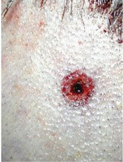 <p>Questions</p><ol><li><p>What is the specimen being examined?</p></li><li><p>What are the specific descriptive characteristics of the wound edges and diameter?</p></li><li><p>What distance of firing is indicated, and why?</p></li><li><p>How is the antemortem nature of this injury determined?</p></li><li><p>What type of causative instrument produced this injury?</p></li><li><p>How is the time of death estimated?</p></li><li><p>What are the possible causes of death?</p></li><li><p>What is the final diagnosis?</p></li></ol><div data-type="horizontalRule"><hr></div><p></p>