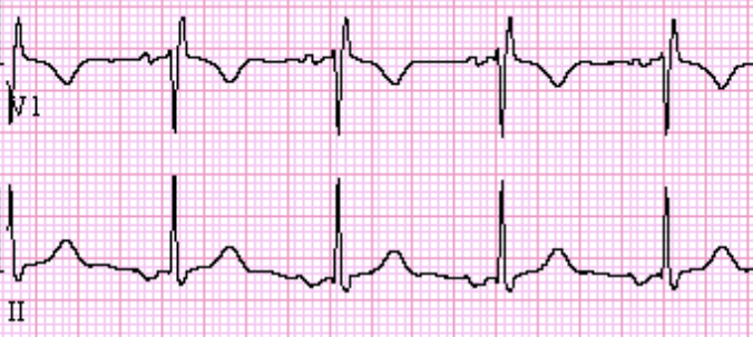 <p>Rate: <100</p><p>Regularity: irregular </p><p>P wave morphology is different </p>