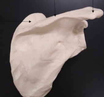 <p>What is this bone? (poking out above the scapular spine)</p>