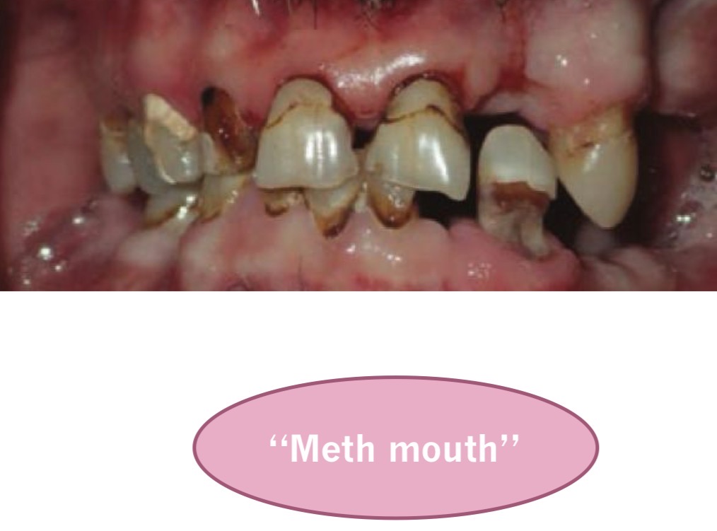 <p>Stimulate CNS and PNS, oral use</p><p>Xerostomia, rampant caries, bruxism</p>