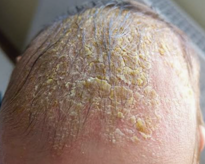 <p>Crusty, oit scales on scalp in newborns (can also be on ears, nose, and groin), disappears over time</p>