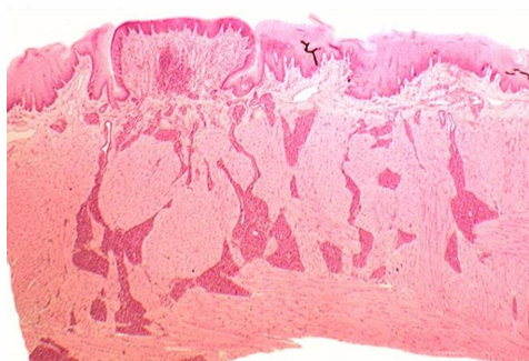 <p>what kind of papillae </p>