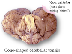 <p>What are life-threatening consequences of tonsillar herniation?</p>