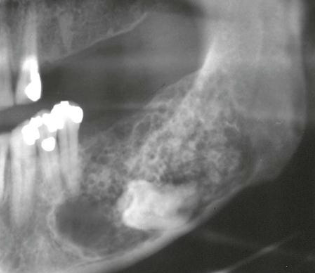 <p>Radiographic Density : a mix of dense tissues (e.g. odontogenic lesions)</p>