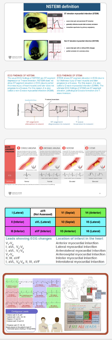 <ul><li><p><span>Diaphoresis</span></p></li><li><p><span>Palpitations</span></p></li><li><p><span>SOB</span></p></li><li><p><span>Watch for atypical presentations such as indigestion, nausea/vomiting, new onset fatigue</span></p></li></ul><p></p>